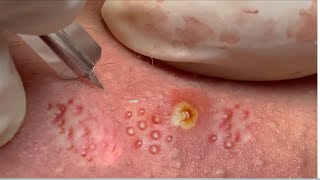 Clear Skin Transformation Acne Treatment amp Blackhead Vanishing 21 [upl. by Leksehc293]