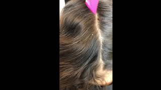 EXTREME HEAD LICE REMOVAL [upl. by Debora]