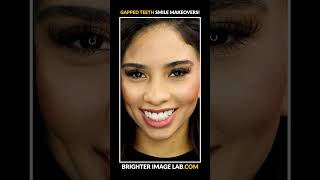 How to Fix Gapped Teeth Brighter Image Lab Dental Veneers shorts [upl. by Whitehouse]