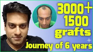 Hair Transplantation Result in 6 Years 4500 DHTFUE grafts NW 34 at 6 years Drs SethiBansal [upl. by Ashli]