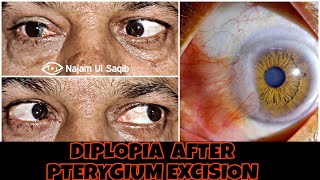 Diplopia After Pterygium Surgery [upl. by Yaffit]