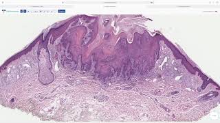 Dermatopathology Keratoacanthoma [upl. by Alohcin]