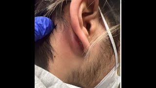 Mastoiditis vs Posterior Auricular Abscess andor Epidermoid Cyst [upl. by Desta]