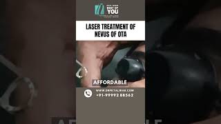 Treatment of Nevus of OTA Removal Procedure Laser Treatment of Nevus of OTA in Delhi Dr PK Talwar [upl. by Bruis]