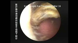 Regular cholesteatoma reexamination and cleaning of the ear [upl. by Tommi796]