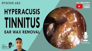 685  Hyperacusis Tinnitus Ear Wax Removal [upl. by Nnaacissej]