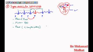 Arrhythmia ECG Dr Mohamad Medhat [upl. by Eelidnarb823]