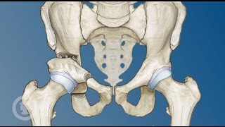 Hip Preservation Options for Young Adults [upl. by Creigh716]