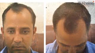 Hair Transplant in Karachi  Amazing Results By AlKhaleej Clinics [upl. by Nashner998]