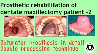 Prosthetic rehabilitation of dentate maxillectomy patient  Part 2 [upl. by Acirtal656]