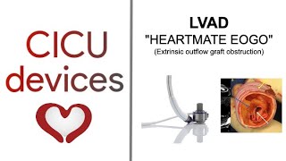 LVAD Heartmate EOGO Extrinsic Outflow Graft Obstruction lvad [upl. by Alyssa938]