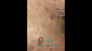 Ingrown Hair Removal  Extraction  Episode 8 [upl. by Bogart]