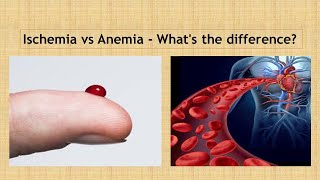 Ischemia vs Anaemia Simple way to learn [upl. by Astrid]