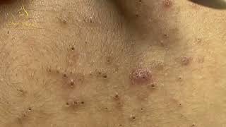 Loan Nguyen Acne Treatment 15566 [upl. by Jerad]