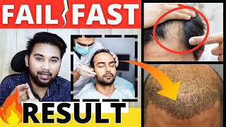 How To Fight Shedding Phase For Faster Hair Transplant Results [upl. by Freud]