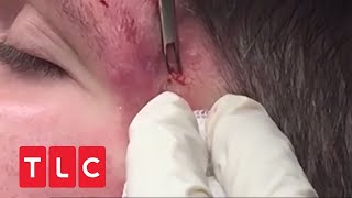 Zyste muss aus Gesicht entfernt werden  Dr Pimple Popper  TLC Deutschland [upl. by Iolanthe]