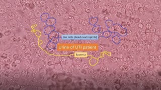 Urine of UTI patient under the Microscope [upl. by Aisela150]