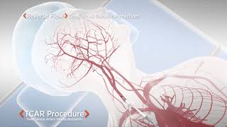 Vídeo Animado  Procedimiento de Revascularización de la Arteria Transcarotídea  TCAR [upl. by Faria777]