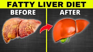 Fatty Liver Diet 5 BEST Foods and 5 To DITCH Meal Plan [upl. by Kanya]