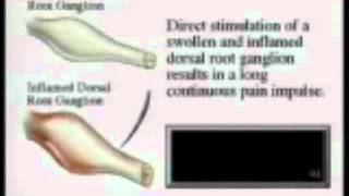 Adhesive Arachnoiditis Stages of Development and Common Cause [upl. by Ahsenwahs]