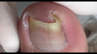 Serious curved nail creates so much pressure and relief it [upl. by Yroffej]