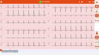 Acquisizione tracciato Ecg con elettrocardiografo Cardioline touch Ecg HD Plus [upl. by Asinet]