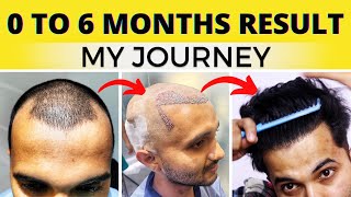 My Full Hair Transplant Journey From Day 1 To 6 Months  Best Hair Transplant Result In India 2022 [upl. by Nwahsear807]