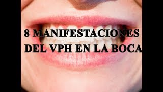 8 manifestaciones de VPH en la boca [upl. by Aicen101]