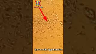 sperm cells agglutination under microscope [upl. by Annehsat]