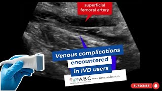 Venous complications encountered in IVD users deep vein thrombosis seroma fistula pseudoaneurysm [upl. by Negroj]