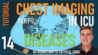 Chest Imaging in ICU  Part 3  Diseases of the Lung in ICU [upl. by Gapin]