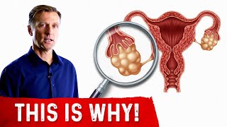 Why Did I Get PCOS Polycystic Ovarian Syndrome [upl. by Nikolos]