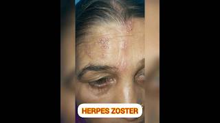 सावधान HERPES ZOSTER हो सकता है  herpesvirus herpes pain shortsfeed shortvideo shorts [upl. by Zwart]