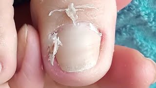 Toenail corners are curved and painful gently  part 64NhaNguyenPhanThiet [upl. by Asare]