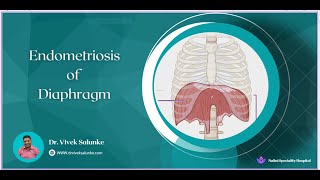 Endometriosis of Diaphragm endometriosisawareness [upl. by Swanhilda]