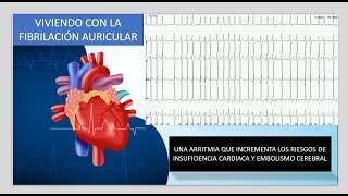 Fibrilación Auricular [upl. by Kirby]