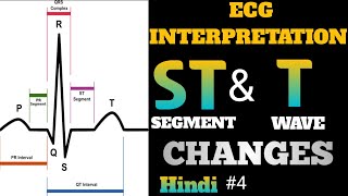 ECG interpretation in hindi  how to read ecg in hindi  ST and T Wave Changes interpretation  4 [upl. by Llirrehs483]