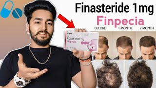 Finpecia Finasteride 1mg Review  Finpecia Side Effects [upl. by Kcirttap]