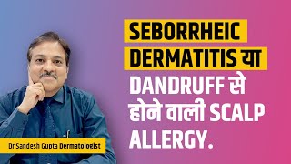 Seborrheic dermatitis या Dandruff से होने वाली scalp allergy Dr sandesh Gupta 9990804085 [upl. by Shamma]