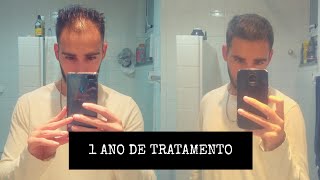 MINOXIDIL  FINASTERIDA 1 ANO DE TRATAMENTO [upl. by Yengac515]