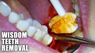 Full Wisdom Teeth Removal Procedure Emergency Extraction of Impacted amp Partially Erupted Molar [upl. by Nabroc32]