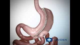 Laparoscopic Sleeve Gastrectomy Covidien video  Jason Free [upl. by Gurolinick]