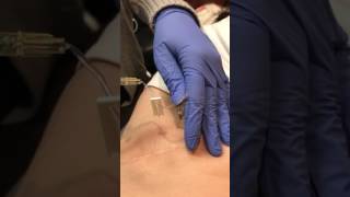 Intrathecal Pain Pump Refill Process [upl. by Mary]