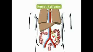 Kolonkarzinom  Lehrvideo [upl. by Niran]