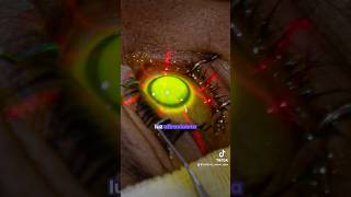 Cirugía de crosslinking corneal ¿ya la conocías  👈🏻👁️ [upl. by Conti166]