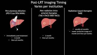 36 Hepatocellular Carcinoma LIRADS Treatment Response after locoregional therapy  Part 1 [upl. by Enairb]