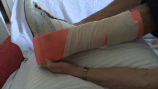 day 14 dislocated foot put shoe back on and splint ankle is unstable [upl. by Onailerua]