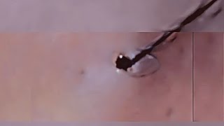 Removal of ingrown hair [upl. by Reizarf]