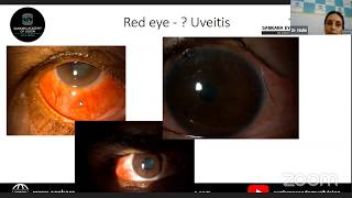 Anterior Uveitis Case Based LiveStream Lecture Series LetsGetonwithExams [upl. by Cott83]