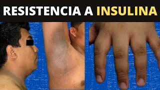 RESISTENCIA A LA INSULINA  ¿Qué le hace a tu cuerpo [upl. by Duff]